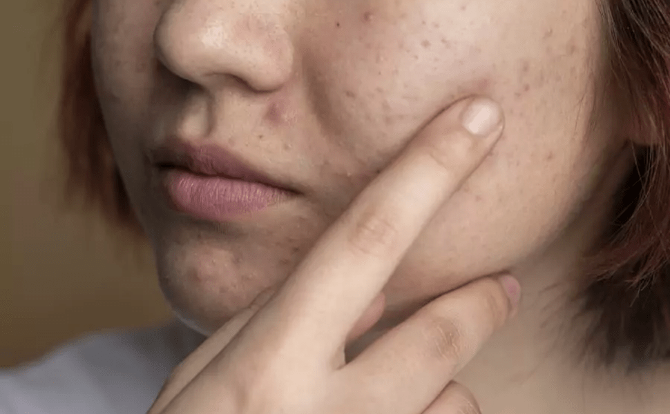ACNE GRADE 1: KNOW THE CHARACTERISTICS AND HOW TO IDENTIFY IT | Creamy ...