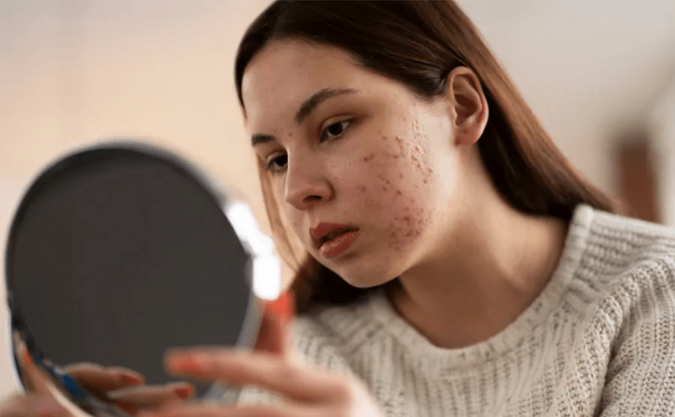 ACNE IN ADOLESCENCE: UNDERSTAND THE CAUSES AND HOW TO TREAT IT